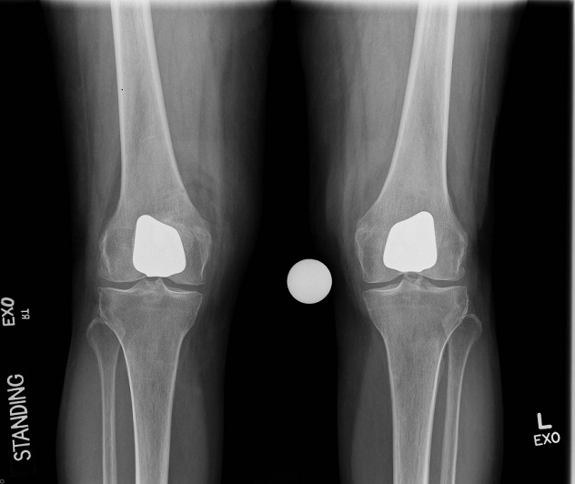 Imagen postoperatoria de las rodillas de un paciente que ha recibido una prótesis parcial de rodilla
