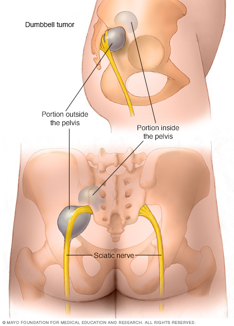 Tumor con forma de reloj de arena