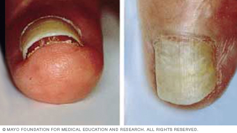 An example of fingernails with nail separation