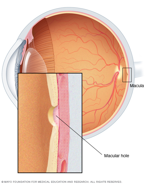 Ilustración de agujero macular
